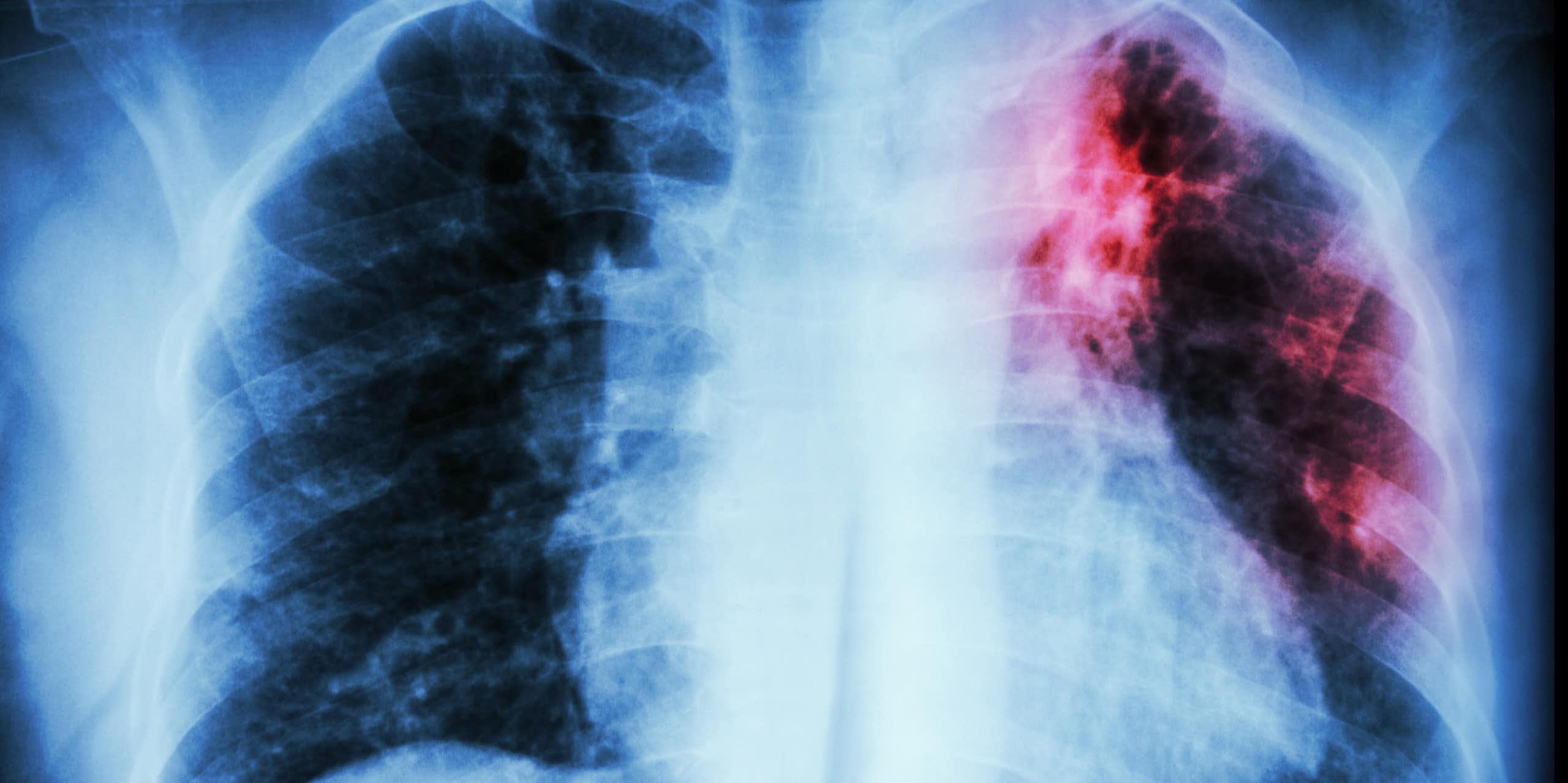 Radiografia de tórax com opacidade vermelha na parte superior do pulmão esquerdo